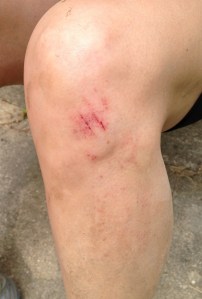 Evidence of falling on a trail run in the daylight